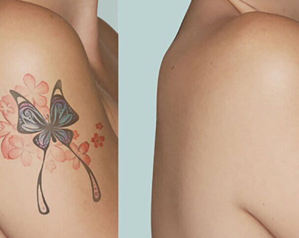 Методики для удаления татуировок на теле