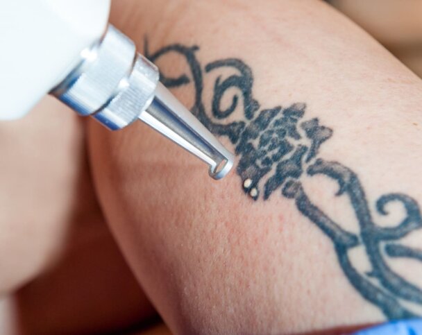 Как лазер удаляет татуировки