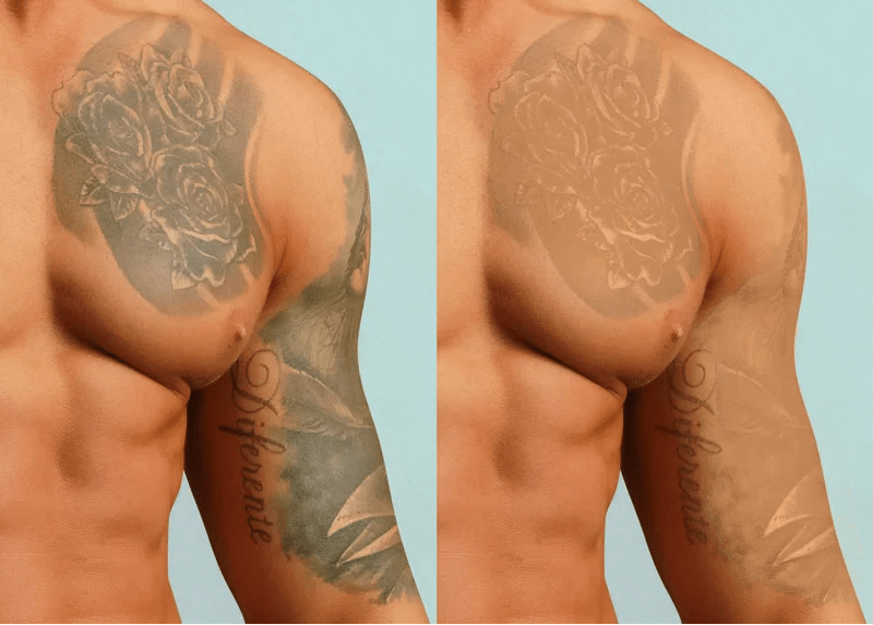 Удаление Татуировки на груди
