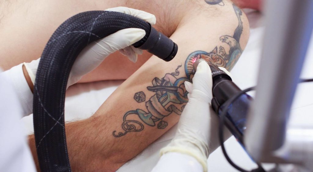 Пикосекундный лазер для удаления тату