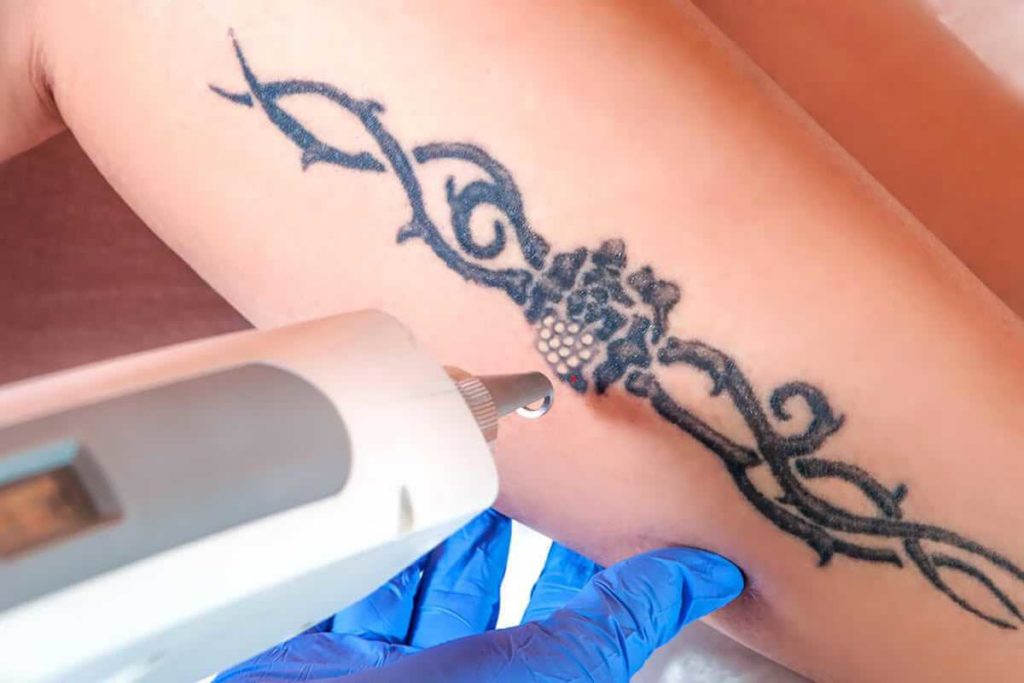 выведение татуировок лазером