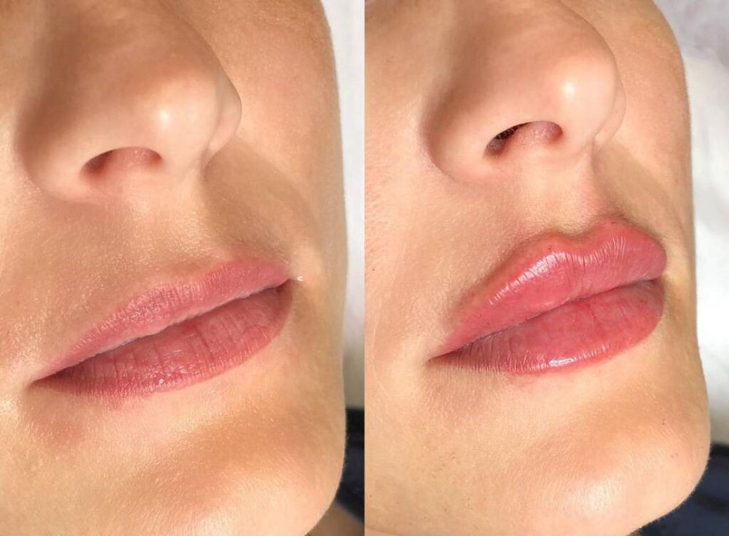 Фото до и после контурной пластики губ