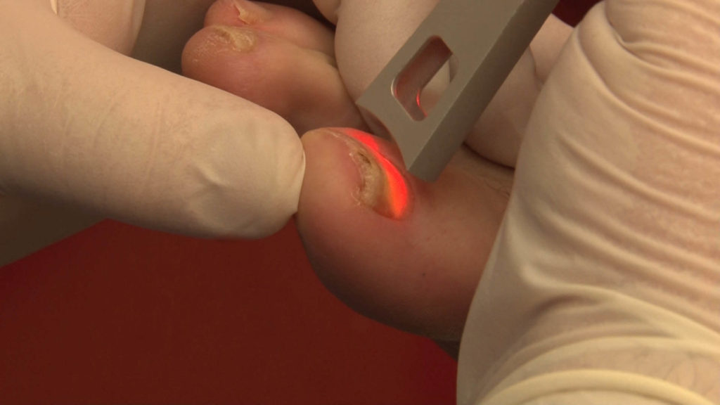 Лечение грибка ногтей лазером Ультрапульс
