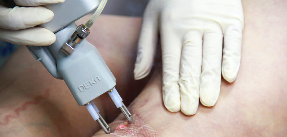 Лазерное лечение шрамов после травм