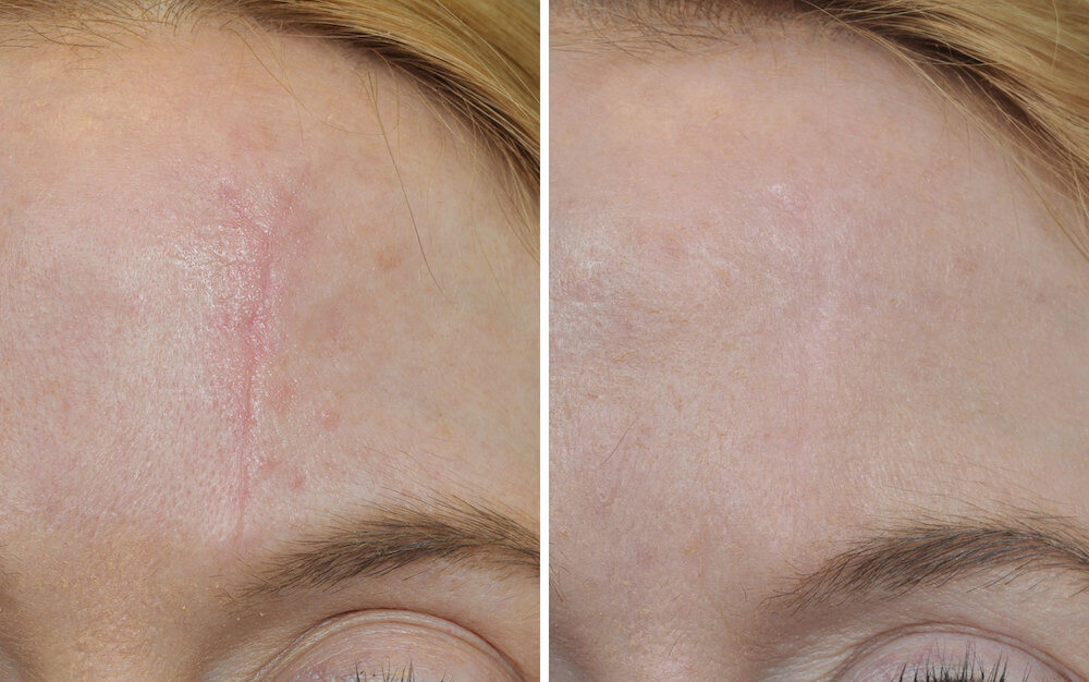 Шрамы на лице – до и после