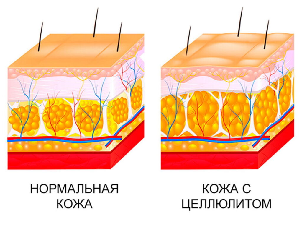 Структура кожи при целлюлите