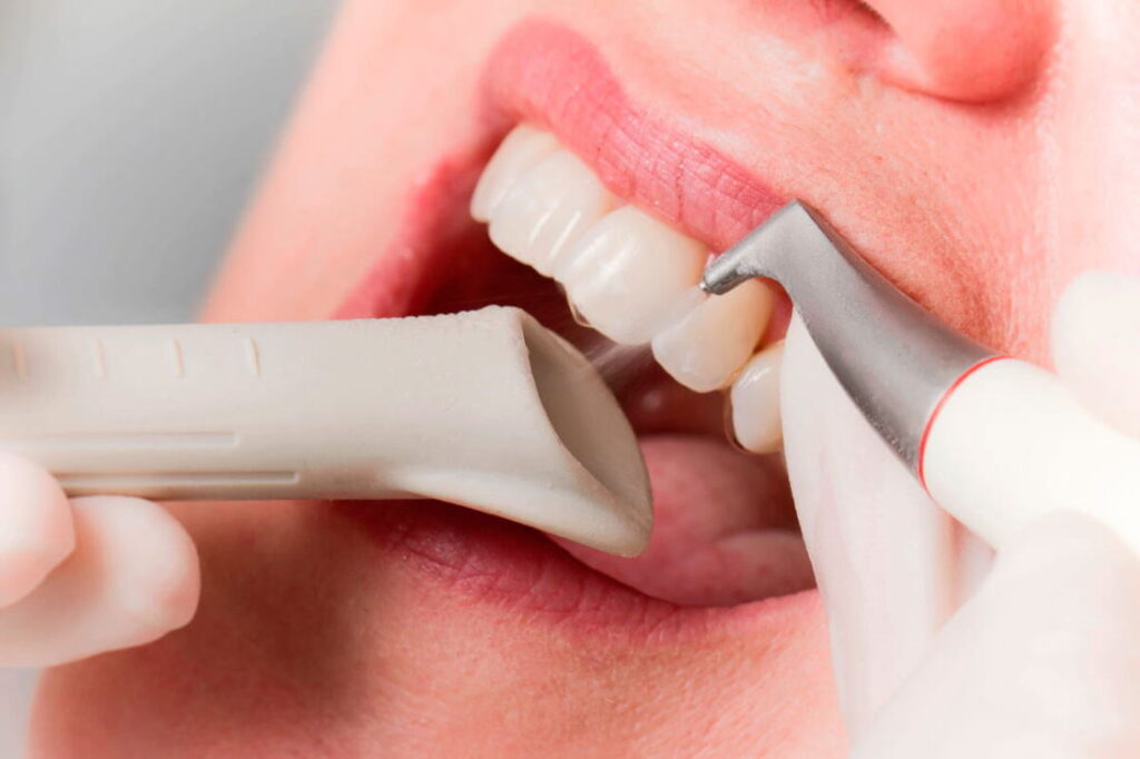 Ультразвуковая чистка полости рта