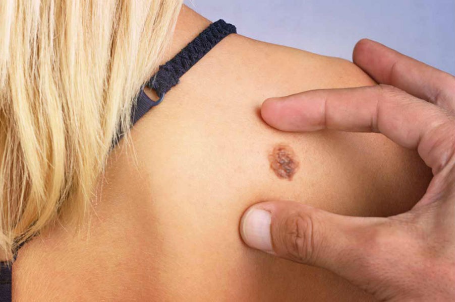 Злокачественные новообразования кожи — виды, симптомы, лечение