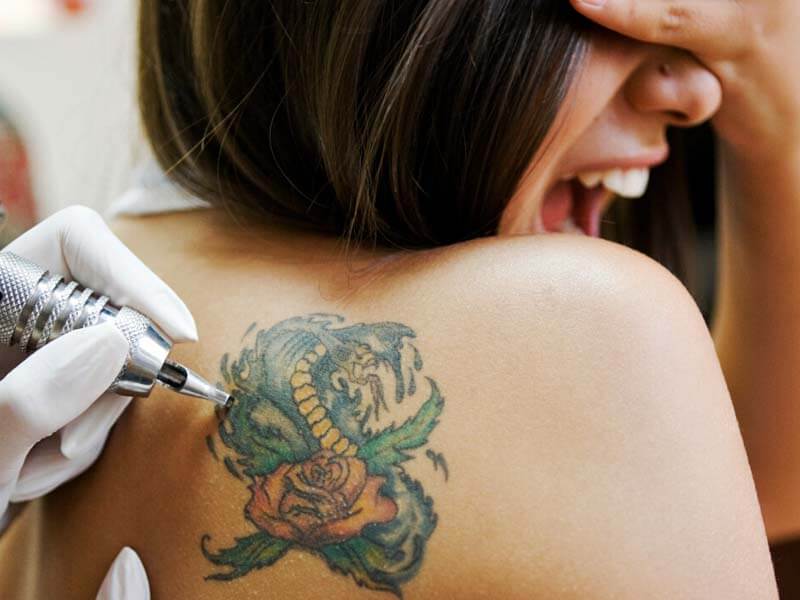  стоимость удаления татуировки