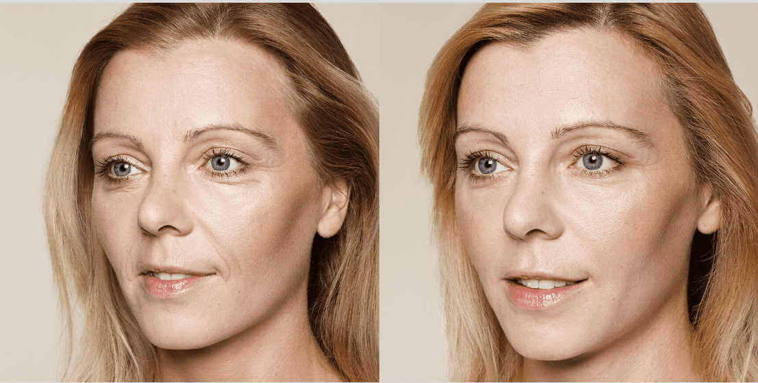 Фото до и после процедуры